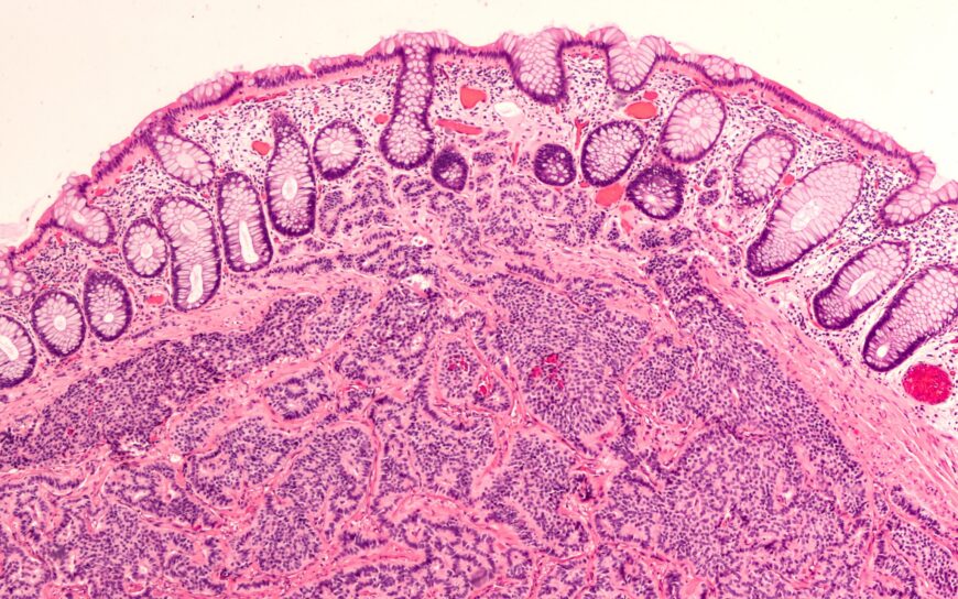 Photomicrograph,Of,A,Carcinoid,Tumor,,A,Type,Of,Neuroendocrine,Tumor